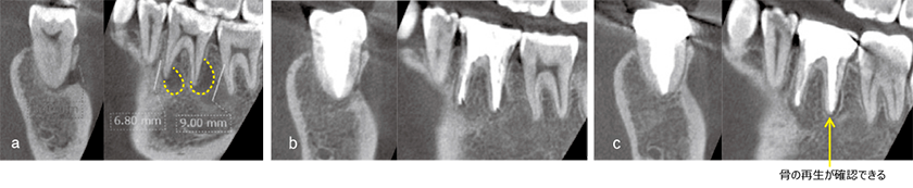 Case 01 Sinus Tract