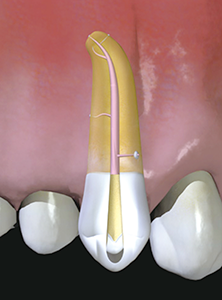 Figure 2: Root canal