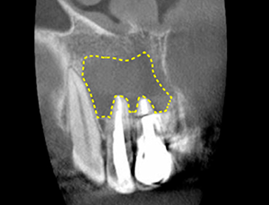 Figure. 6 Tooth with significant dissolution around the root
