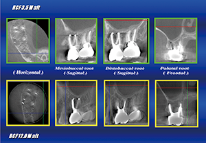 Figure 7: Radiograph after EMAT treatment