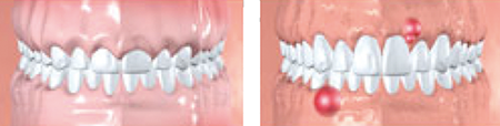 Figure 10: Healthy gums (left) and gums affected by periodontal disease