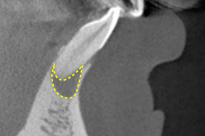 Figure 13: root canal lesion