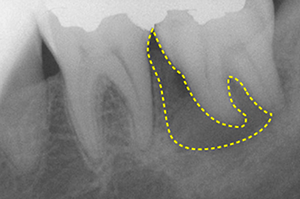 Figure 14: periodontal disease