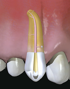 Figure 15: Cavity in the root canal