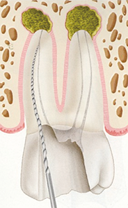 Figure 17: Clean contaminants with files