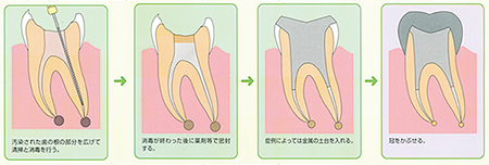 Figure 18: endodontia