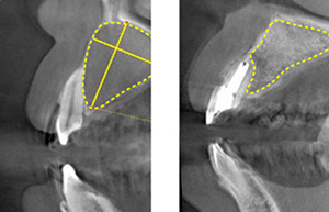 Figure 19: Before and after root canal treatment