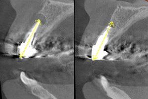 Figure 20: Radiographic image of root tip cut away